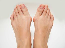Bunion case study 1